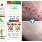 Aichun Beauty – Anti  acne Cream