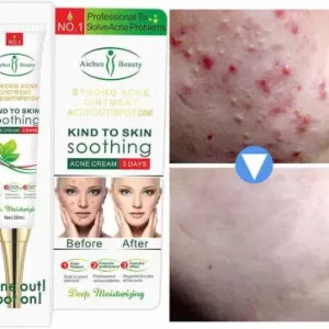 Aichun Beauty - Anti  acne Cream