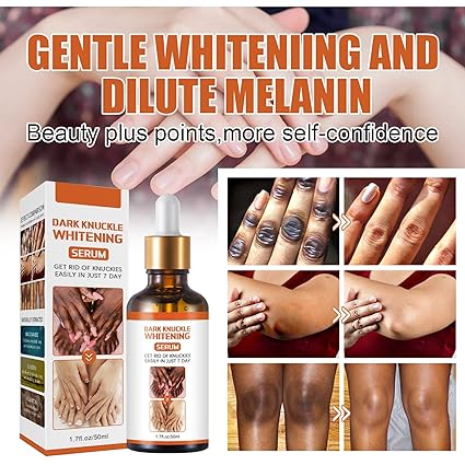 Skin Whitening Oil,dark Knuckle Whitening Serum, Strong Whitening Serum Removing Dark Knuckle Finger Elbow and Knee (1 Bottle) - Image 2