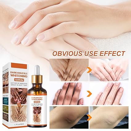 Skin Whitening Oil,dark Knuckle Whitening Serum, Strong Whitening Serum Removing Dark Knuckle Finger Elbow and Knee (1 Bottle) - Image 3